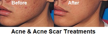 Acne and Acne Scar Removal Treatments