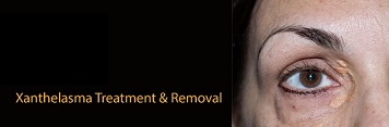 Xanthelasma Removal